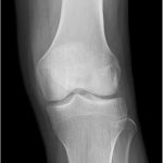Fig. 5-A Anteroposterior radiograph of the left knee.
