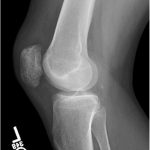 Fig. 5-B Lateral radiograph of the left knee.
