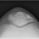 Fig. 5-C Sunrise radiograph of the left knee.
