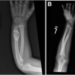 Fig. 1 Fig. 1-A Posteroanterior radiograph of the forearm at initial presentation showing a pathologic fracture through a lucent lesion in the distal aspect of the ulna. The lesion, which has a sclerotic border, is mildly expansile and exhibits calcification. Fig. 1-B Anteroposterior radiograph of the forearm at 18 months after surgery showing healing of the pathologic fracture as well as a decrease in sclerosis and size of the lesion with no recurrence and maintained alignment.

