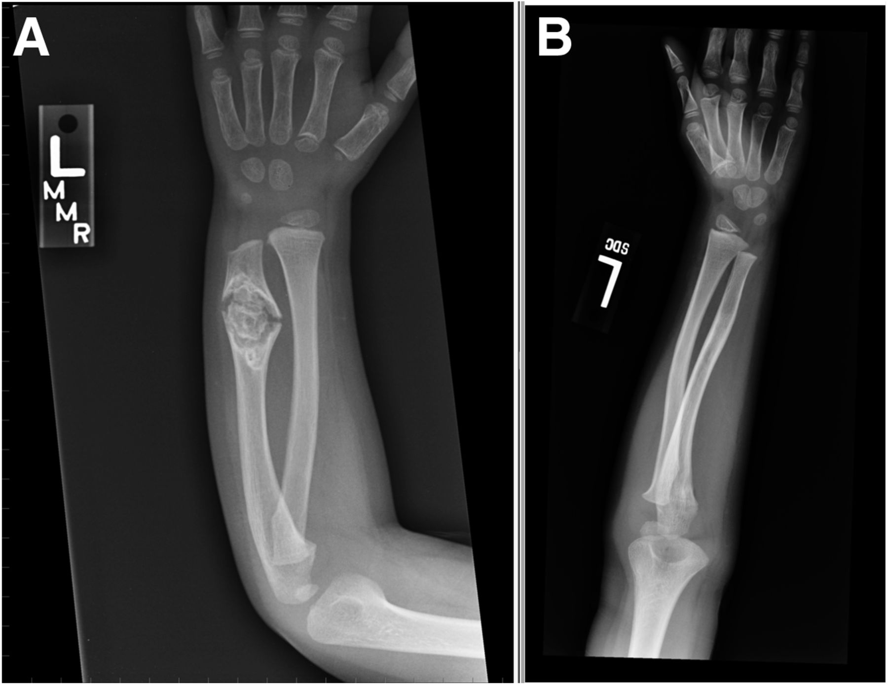 A 3 Year Old Boy With Swelling Of The Left Forearm Following An 