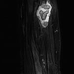 Fig. 2 T2-weighted coronal MRI of the distal aspect of the ulna showing a lesion with mixed signal intensity measuring 1.8 × 3 cm, with a central calcification containing ununited fragments representing a pathologic fracture.

