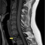 Fig. 1-A Sagittal T1-weighted MRI demonstrating a hypointense marrow-infiltrating lesion (arrow) of the entire first thoracic vertebral body.
