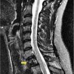 Fig. 1-B Sagittal T2-weighted fat-suppressed MRI demonstrating a hypointense marrow-infiltrating lesion (arrow) of the entire first thoracic vertebral body.
