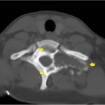 Fig. 3 Axial CT scan of T1, made 1 year after the initiation of denosumab treatment, demonstrating a predominantly lytic lesion of the transverse process with partial extension into the vertebral body and posterior elements (arrows).
