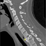 Fig. 4-B CT scan of the cervical spine, made 9 months after the cessation of denosumab treatment. Sagittal reformatted scan demonstrating a compression deformity of the T1 vertebral body (arrow).
