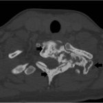 Fig. 5-A Axial CT scan, made 16 months after the cessation of denosumab, demonstrating further progression of the mixed lytic and sclerotic T1 lesion (arrows).
