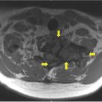 Fig. 6-A Preoperative MRI scan of the cervicothoracic spine, showing enlarged lesion (arrows) involving the T1 vertebral body. T1-weighted precontrast axial scan.
