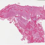 Fig. 7-A Photomicrograph showing the histological features of resection specimen. Lower-power view illustrating the recurrent tumor, composed in part of extensive new-bone formation, especially peripherally (original magnification, ×3).
