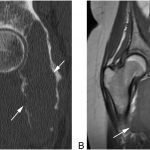 Fig. 2 Sagittal CT (Fig. 2-A) and coronal T1-weighted MRI (Fig. 2-B) of the pelvis demonstrate the size of the mass and its involvement of the posterior column of the acetabulum.
