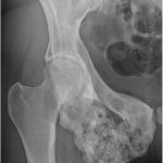 Fig. 4 Anteroposterior radiograph of the pelvic lesion following embolization and 20 months of treatment with denosumab shows a mixed lytic and sclerotic mass in the location of the original lesion.
