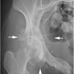 Fig. 7 Anteroposterior radiograph made 7 months after surgical resection of the ischiopubic mass shows interval development of a lytic and sclerotic periacetabular lesion and a soft-tissue component with ossification (arrows).
