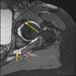 Fig. 2 Axial T2-weighted TRUFI (true fast imaging with steady-state free precession) 3-dimensional MRA scan demonstrating the small anterosuperior labral tear (long yellow arrow). A cystic abnormality can also be seen at the dorsal aspect of the acetabulum (short yellow arrow) next to the sciatic nerve (red arrow).
