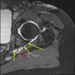 Fig. 3-A MRI scan demonstrating the cystic lesion. Axial T2-weighted TRUFI fast-spin-echo MRI scan with fat saturation, demonstrating the lesion at the dorsal aspect of the acetabulum (short yellow arrows) and its filiform connection to the hip joint (long yellow arrow); the sciatic nerve (red arrow) is directly adjacent and posterior to the lesion.
