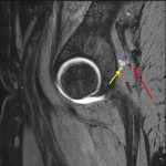 Fig. 3-B MRI scan demonstrating the cystic lesion. Sagittal T2-weighted DE (double-echo) MRI scan with fat saturation, demonstrating the proximity of the lesion (yellow arrow) to the dorsal aspect of the acetabulum and directly adjacent to the sciatic nerve (red arrow).
