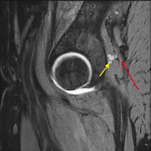 A 48-Year-Old Woman with Intermittent Groin Pain - JBJS Image Quiz