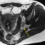 Fig. 3-D MRI scan demonstrating the cystic lesion. Axial T2-weighted MRI scan showing the dark outlined, distended sciatic nerve resembling an inverted digit “3” (arrow). The bright-colored lesion is located within the nerve like an intrinsic mass. Displaying a “claw-sign”-like topography, the nerve forms sharp angles on either side of the mass, which is highly suggestive of an intraneural course of the lesion on its intrapelvic course.
