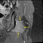 Fig. 3-E MRI scan demonstrating the cystic lesion. Coronal fat-saturated intermediate-weighted MRI sequence of the left hip, showing edema of the quadratus femoris muscle (arrows).
