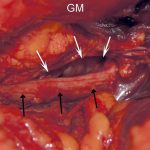 Fig. 4-A Intraoperative photograph showing the cystic ganglion (white arrows) behind the sciatic nerve (black arrows), posterior to the greater trochanter (GT) and the gluteus medius (GM).
