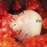 Fig. 4-D Intraoperative photograph, made after surgical dislocation, showing the femoral head (FH) mild cam-type deformity (arrows) in the anterosuperior aspect.
