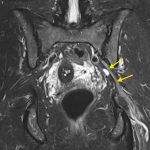 Fig. 5 Postoperative coronal STIR (short-tau inversion recovery) MRI scan, showing complete recovery of the sciatic nerve (arrows) without any sign of residual cystic structures.
