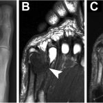 Fig. 1 Imaging. Fig. 1-A Oblique radiograph of the left foot showing a mass (arrow) along the medial side of the fifth metatarsal head and MTP joint with internal calcifications and osseous erosion. Fig. 1-B T1-weighted MRI showing a mass (arrow) in the space between the fourth and fifth metatarsals, eroding the distal fifth metatarsal bone and measuring 1.8 × 2.1 × 2.5 cm (anteroposterior × transverse × craniocaudal). Fig. 1-C T2-weighted MRI showing heterogeneous hyperintense fluid signal within the mass (arrow) and substantial adjacent osseous edema.
