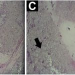 Fig. 2 Fig. 2-A Intraoperative photograph showing the mass in situ. Fig. 2-B Hematoxylin and eosin stain (low magnification) showing chondroid tissue (lighter central and peripheral zones) surrounded by darker grainy zones. Fig. 2-C Hematoxylin and eosin stain (high magnification) showing a central area of chondroid tissue (star) surrounded by darker material (arrow). Inflammatory cells, including multinucleated giant cells, are noted in the right middle zone. Fig. 2-D Polarized light microscopy utilizing a first-order analyzer. The arrow indicates the direction of the slow axis of the compensator plate.
