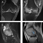 Fig. 1 Initial MRI scan of the right knee that was ordered by the referring orthopaedist (Fig. 1-A) and MRI scans that were made at our institution four months later because of progressive symptoms (Figs. 1-B, 1-C, and 1-D). Fig. 1-A Coronal T2-weighted image with fat suppression, demonstrating an area of high signal intensity in the medial femoral condyle. There is degenerative signal within the expanded body of the lateral meniscus. No subchondral fracture was identified. Fig. 1-B Coronal T2-weighted image with fat suppression, showing interval progression of area of high signal intensity of the medial femoral condyle with new involvement of the lateral femoral condyle and medial tibial plateau. Fig. 1-C Sagittal T2-weighted image with fat suppression, demonstrating high signal intensity of the medial femoral condyle and the medial tibial plateau. Fig. 1-D Sagittal proton-density image showing an insufficiency fracture of the posterior aspect of the lateral femoral condyle (arrow).
