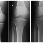Fig. 2 Radiographs of the right knee, showing progression of osteopenia. Fig. 2-A Radiograph made at the time of presentation to the referring orthopaedist, showing no evidence of osteopenia. Fig. 2-B Radiograph made two months later, showing focal osteopenia in the medial femoral condyle. Fig. 2-C Radiograph made 3.5 months after the initial radiographs, showing persistent osteopenia of the medial femoral condyle and development of focal osteopenia in the lateral femoral condyle and medial tibial plateau. The mottled appearance within the joint space is not chondrocalcinosis as it is not calcific density and does not have the linear appearance of something confined to the hyaline articular cartilage or fibrocartilage of the meniscus. In addition, no tophus was identified on MRI or arthroscopy.

