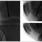 Fig. 3 Intraoperative fluoroscopic images of the right knee, showing subchondral drilling of the medial and lateral femoral condyles.

