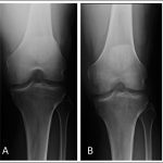 Fig. 4 Radiographs of the left knee, showing development of osteopenia. Fig. 4-A Radiograph made at the time of presentation, showing no evidence of osteopenia. Fig. 4-B Radiograph made two months after presentation, showing evidence of focal osteopenia in the medial femoral condyle.
