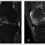 Fig. 5 MRI scans of the left knee, made three months after presentation. Fig. 5-A Coronal T2-weighted image with fat suppression, demonstrating bone marrow edema in the medial femoral condyle and a lateral meniscus tear. Fig. 5-B Sagittal T2-weighted image with fat suppression, showing bone marrow edema in the medial femoral condyle.
