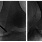Fig. 6 Intraoperative fluoroscopic images of the left knee, showing subchondral drilling of the medial femoral condyle.
