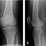 Fig. 7 Weight-bearing anteroposterior (Fig. 7-A) and lateral (Fig. 7-B) radiographs of the left knee, made nine months after surgery, showing resolution of osteopenia and normal bone density. There is no evidence of collapse or arthritis.
