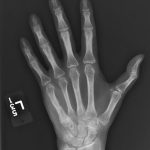 Fig. 1 Anteroposterior radiograph of the left hand demonstrating a soft-tissue mass, cortical irregularity, and osseous destruction.
