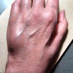 Fig. 2 Clinical photograph showing erythema and swelling over the ulnar aspect of the hand.
