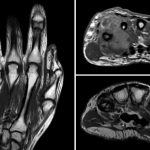 Fig. 3 T1-weighted MRI series demonstrating a mass occupying the intramedullary space with a large soft-tissue component abutting the fourth metacarpal. Note the abnormal intramedullary signal throughout the fifth metacarpal, suggesting an infiltrative, marrow-replacing process.
