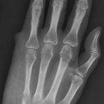 Fig. 4-C Anteroposterior radiograph of the left hand demonstrating the extent of the resection.
