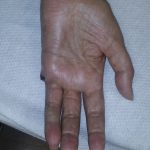Fig. 6-A Postoperative clinical photograph. The volar aspect of the hand at the first postoperative visit.
