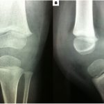 Fig. 1 Anteroposterior (Fig. 1-A) and lateral (Fig. 1-B) radiographs of the knee joint.
