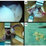 Fig. 3 Perioperative images. Fig. 3-A Arthroscopic view of loose bodies in the anterior compartment. Fig. 3-B Parapatellar anterior approach and loose bodies. Fig. 3-C Posterior approach and osteochondral fragments. Fig. 3-D Resected loose bodies.
