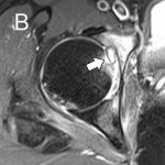 Fig. 1 Preoperative imaging showing the lesion (arrowheads and arrow) on a radiograph (Fig. 1-A), T1-weighted fat-suppressed axial MRI with gadolinium enhancement (Fig. 1-B), and SPECT/CT with focal hot uptake (Fig. 1-C).
