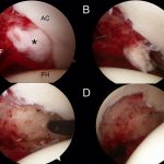 Fig. 2 Arthroscopic views of the lesion in the acetabular fossa (Fig. 2-A), during the en bloc excision (Fig. 2-B), after the excision (Fig. 2-C), and after the thermal synovectomy had been performed (Fig. 2-D). * = solitary lesion, AC = acetabular cartilage, AF = acetabular fossa, and FH = femoral head.
