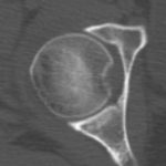 Fig. 4 Postoperative CT showing complete excision of the lesion.
