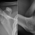 Fig. 1 Anteroposterior (left) and axillary (right) radiographs of the right shoulder show no osseous abnormality.
