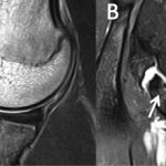 Fig. 3 Axial proton density (Fig. 3-A) and T2-weighted fat-suppressed (Fig. 3-B) ABER (abduction external rotation) MRI arthrograms, performed 8 months after initiating nonoperative treatment, demonstrate an interval decrease in subchondral sclerosis and in the marrow edema of the osteochondral lesion involving the central and posterior margins of the glenoid (arrows), indicative of a healed lesion.
