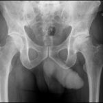 Fig. 1 Preoperative anteroposterior pelvic radiograph showing reduced joint space and subchondral sclerosis consistent with osteonecrosis in the left hip joint.
