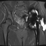 Fig. 3 MARS MRI (coronal view) T2-weighted fat-saturation image of the pelvis shows a large fluid collection overlying the proximal aspect of the left femur, which appeared to be arising from the anterior aspect of the hip joint.
