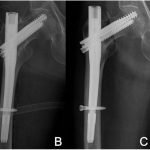 Fig. 1 Fig. 1: Radiographs. Fig. 1-A Stable 2-part intertrochanteric fracture that extended along the intertrochanteric line through the greater trochanter. Fig. 1-B Fine position of the 2 integrated screws and the tight-fitting nail within the medullary canal were observed on the immediate postoperative anteroposterior radiograph. Reduction of the fracture fragment was within the acceptable range. Fig. 1-C Complete union had been achieved, but there was a varus collapse of 5° compared with the previous radiograph, and a slight shift of the nail tip to the lateral cortex was observed 1 year postoperatively. Fig. 1-D Anteroposterior radiograph 3.5 years after the initial surgery showing focal eccentric sclerosis of the lateral cortex at the distal screw and thinning of the lateral femoral cortex as the nail tip shifted to the lateral cortex.
