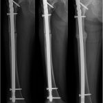 Fig. 3 Fig. 3: Radiographs after the revision surgery. Internal fixation was performed with a long intramedullary nail. Fig. 3-A After surgery, the alignment of the femoral shaft became straight, as did that of the nail. Fig. 3-B At the 4-month follow-up, the radiograph showed progression of the fracture union. Fig. 3-C At 12 months postoperatively, the radiograph showed complete union of the fracture.

